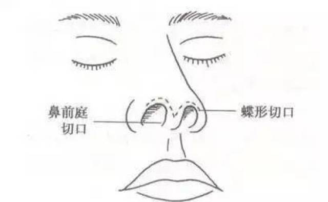 最新隆鼻方法，塑造完美鼻梁的艺术之旅探索